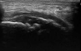 Echografisch beeld van Sever Schinz Echografisch beeld van Sever Schinz